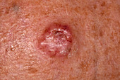 Secondary skin cancer on the forehead