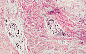 Neurofibroma, light micrograph