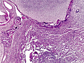 Meningioma, light micrograph