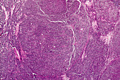 Non-Hodgkin's lymphoma, light micrograph