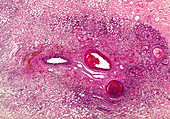 Coagulative necrosis of the spleen, light micrograph