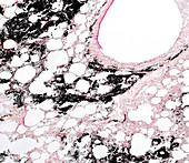 Lung anthracosis, light micrograph