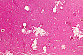 Purulent meningitis, light micrograph