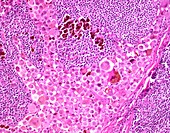 Lymph node metastasis in melanoma, light micrograph