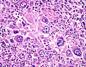 Giant cell melanoma, light micrograph