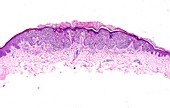 Superficial spreading melanoma, light micrograph