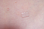 Hormone replacement therapy transdermal patch