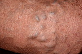 Varicose veins