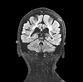 Multiple sclerosis, coronal brain MRI scan