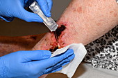 Dressing a pyoderma ulcer wound