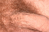 Penile Mondor's disease