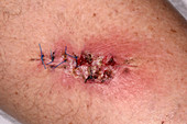 Infected wound