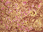 Large B cell lymphoma, LM