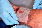 Treating haematoma after an injury