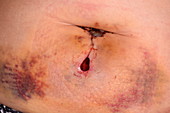 Open wound after small bowel surgery