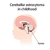 Cerebellar astrocytoma in childhood, illustration