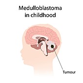 Medulloblastoma in childhood, illustration