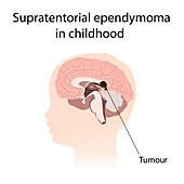 Supratentorial ependymoma in childhood, illustration