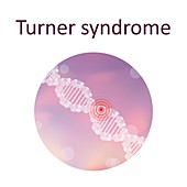 Turner syndrome, illustration