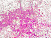 Adrenal cortical adenoma, light micrograph