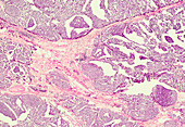Medullary cancer of the breast, light micrograph