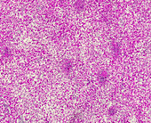 Congenital syphilis of the liver, light micrograph