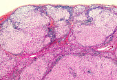 Hepatic cirrhosis of the liver, light micrograph