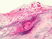 Epididymal tuberculosis, light micrograph