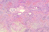 Fatal fulminant hepatitis, light micrograph