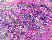 Tuberculosis granuloma, light micrograph