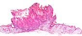 Actinic keratosis, light micrograph