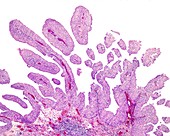 Papillary carcinoma of bladder, light micrograph