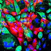 Prostate cancer cells, fluorescent light micrograph