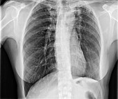 Tuberculosis scarring, X-ray