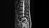 Spinal compression, CT scan