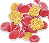 Leukaemia blood cells, SEM