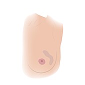 Texture and colour change in female breast, illustration