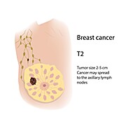 Breast cancer at stage T2, illustration