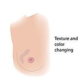 Texture and colour change in female breast, illustration
