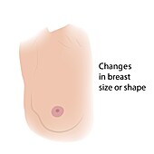 Changes in female breast size or shape, illustration