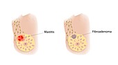 Mastitis and fibroadenoma, illustration