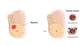 Mastitis and ductal cancer, illustration