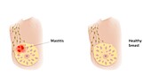 Healthy breast and mastitis, illustration