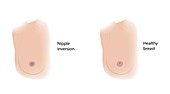 Healthy breast and nipple inversion, illustration