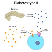 Diabetes type 2, illustration