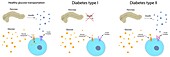Diabetes and healthy glucose metabolism, illustration