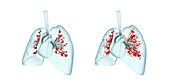 Viral lung infection, illustration