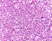 Chromophobe renal cell carcinoma, light micrograph