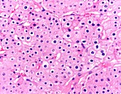 Chromophobe renal cell carcinoma, light micrograph