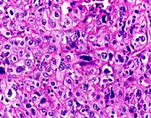 Clear cell renal cell carcinoma, light micrograph